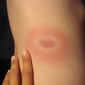 Maladie de Lyme